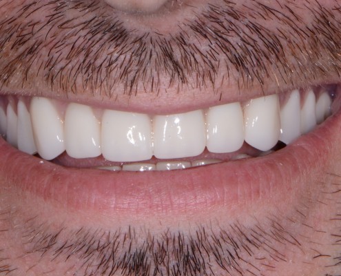 Front Teeth Dentures Auburn PA 17922